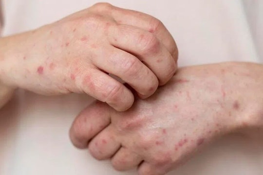 Thêm một ca bệnh đậu mùa khỉ tại TP.HCM