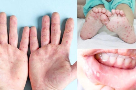 Trên cả nước có hơn 86.000 ca mắc bệnh tay chân miệng