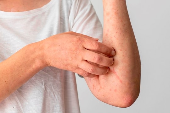 Kết quả giải mã gene của ca bệnh đậu mùa khỉ "nội địa" đầu tiên