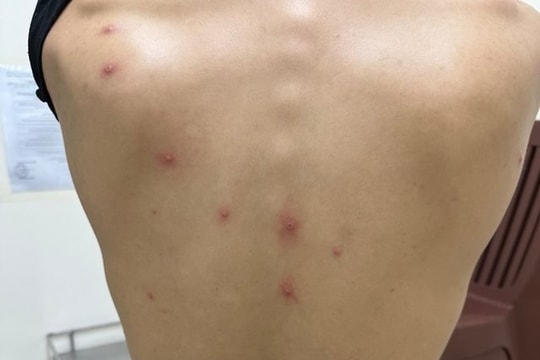TP.HCM phát hiện ca bệnh đậu mùa khỉ thứ 5