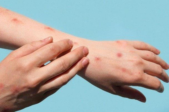 TP. HCM ghi nhận 13 ca mắc đậu mùa khỉ
