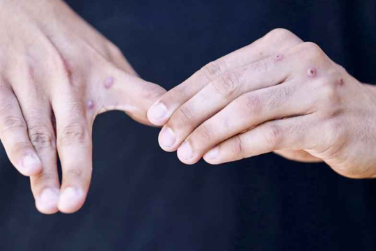 Long An phát hiện ca đậu mùa khỉ đầu tiên