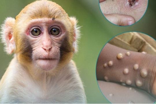 Giám sát chặt nguồn lây đậu mùa khỉ