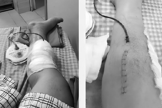 Suýt mất chân do tự "kết hợp đông - tây y" trị bệnh gout