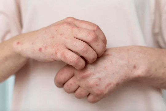 TP.HCM ghi nhận thêm 6 ca đậu mùa khỉ trong tuần