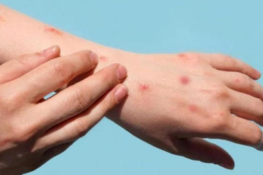 Khẩn trương xử lý ca nghi mắc bệnh đầu mùa khỉ tại Đà Nẵng 