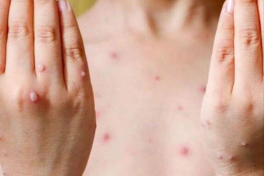 Công bố kết quả xét nghiệm bệnh nhân nghi mắc bệnh đậu mùa khỉ ở Đà Nẵng