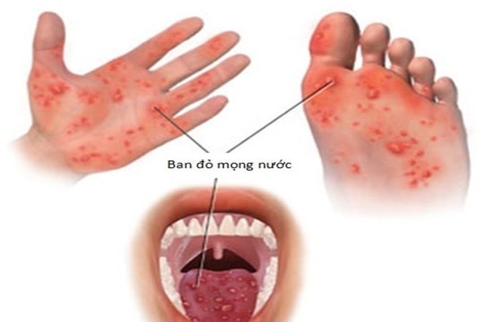 TP.HCM phát hiện 18/20 ca mắc đậu mùa khỉ nhiễm HIV