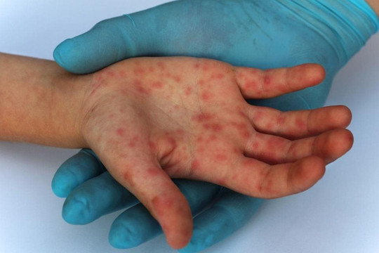 18 ca mắc đậu mùa khỉ đang điều trị tại TP.HCM nhiễm HIV