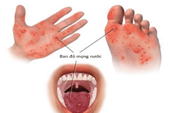 Không thiếu thuốc điều trị bệnh tay - chân -  miệng