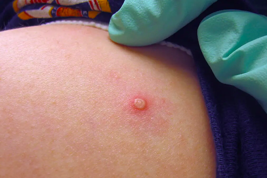 Người đàn ông tử vong sau 10 ngày điều trị bệnh đậu mùa khỉ