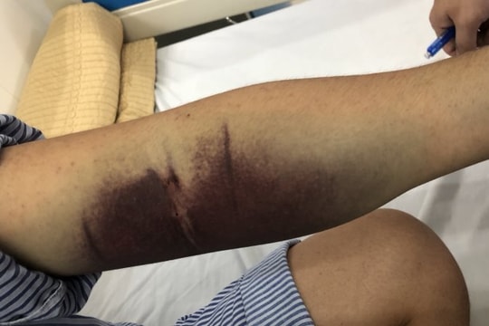 Người bệnh tiểu đường nguy cơ cao gặp biến chứng khi bị sốt xuất huyết