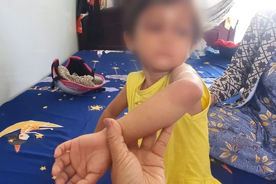 Xác minh, làm rõ vụ bé gái 4 tuổi nghi bị cha nuôi bạo hành