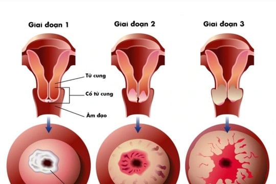 Phái đẹp yêu bản thân, đừng quên chủ động tầm soát ung thư cổ tử cung