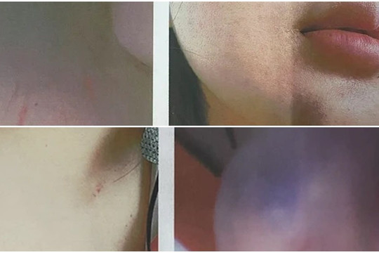 Vụ nữ sinh "tố" bị phụ huynh đánh hội đồng: Nhà trường nói gì?