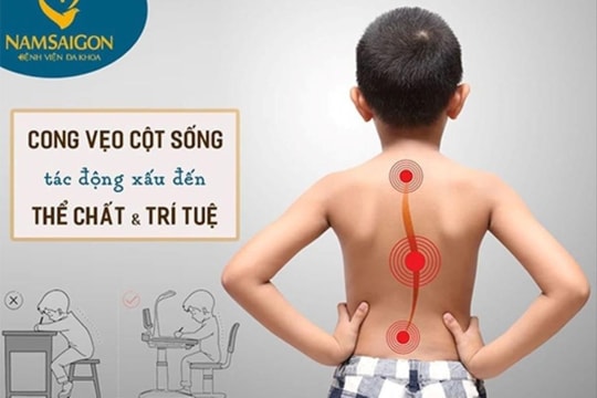  Gia Lai: 1.139 học sinh có dấu hiệu cong vẹo cột sống qua khám sàng lọc