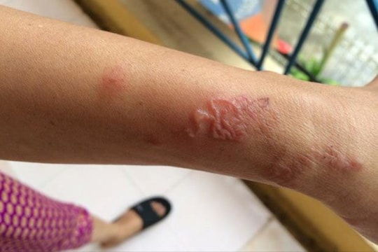 Cảnh báo nhiễm ký sinh trùng do thú nuôi