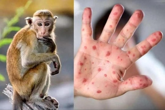 Hà Nội tăng cường giám sát bệnh đậu mùa khỉ