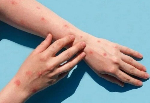 Kiên Giang phát hiện 3 ca mắc bệnh đậu mùa khỉ