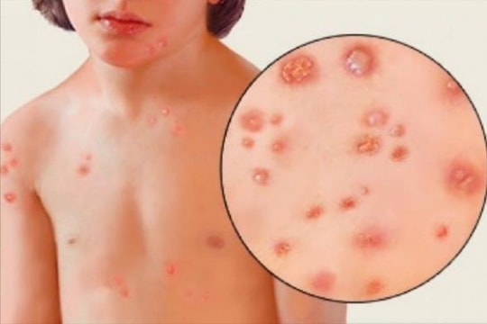 Nguy cơ gia tăng ca bệnh thủy đậu trong thời tiết giao mùa