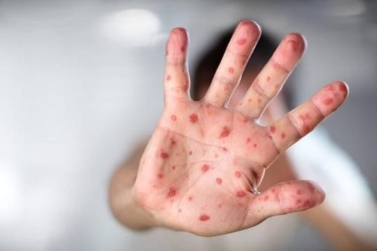 TP.HCM phát hiện gần 1.500 ca tay chân miệng trong 3 tháng