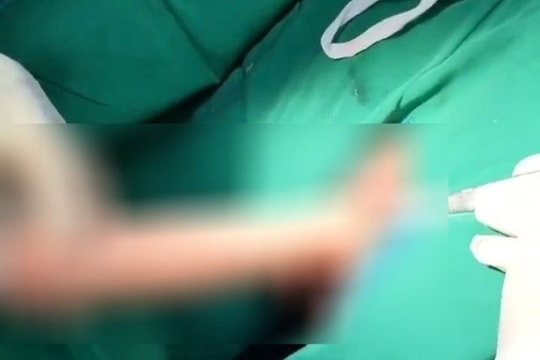 Nam thanh niên nhập viện do "nghịch dại" với dương vật giả