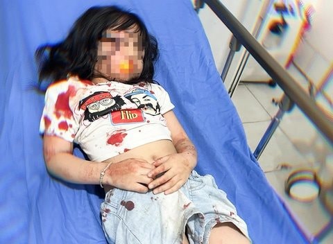 Chó thả rông cắn 4 người khiến một cháu bé phải nhập viện