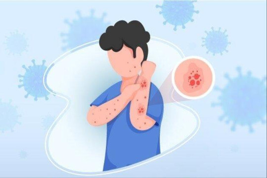 Giám sát chặt chẽ các trường hợp nghi sởi, rubella trên địa bàn Hà Nội