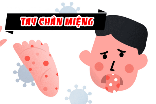 Quyết liệt các giải pháp phòng, chống dịch bệnh tay chân miệng