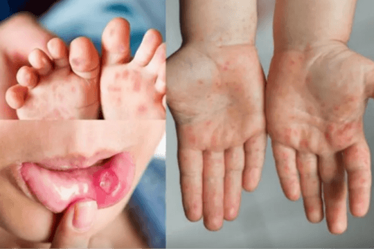 3 ổ dịch tay chân miệng tại Hà Nội được phát hiện