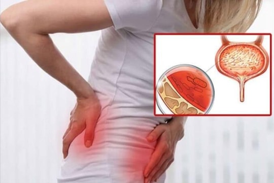 Bệnh nhân có 2 bàng quang được phẫu thuật thành công