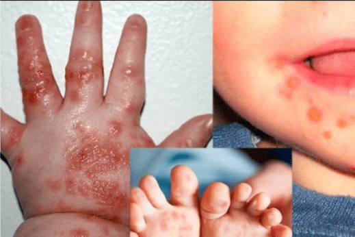 Hà Nội: Số ca mắc tay chân miệng đang gia tăng