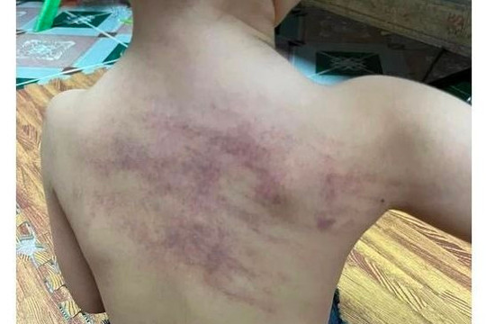 Vụ cháu bé 5 tuổi bầm tím lưng ở Hải Phòng: Yêu cầu có hình thức kỷ luật tập thể, cá nhân liên quan