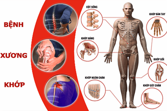 Thách thức của bệnh xương khớp: Lối sống và nhận thức