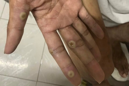 Ghi nhận ca đậu mùa khỉ đầu tiên ở huyện Trảng Bom