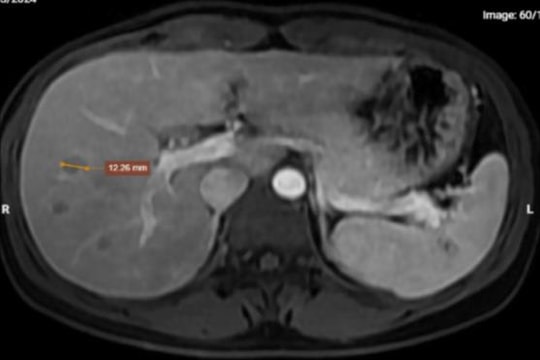 Sốc nặng khi phát hiện mắc ký sinh trùng từ thói quen không ngờ