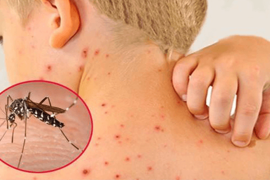 Hà Nội: Sốt xuất huyết diễn biến phức tạp
