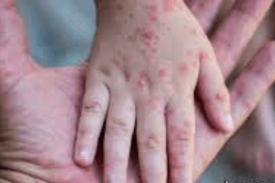 TP.HCM: Số ca nhiễm bệnh sởi gia tăng