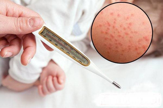 TP. HCM ghi nhận thêm 106 ca bệnh sởi