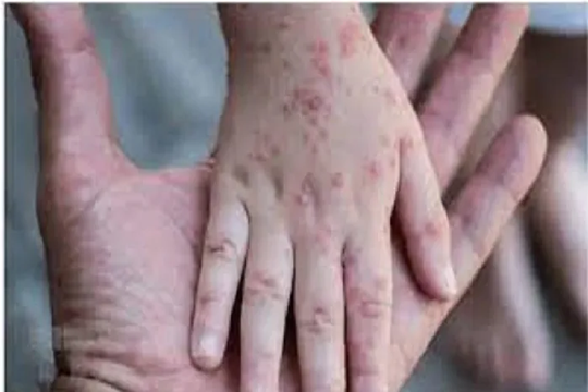 Bộ Y tế tăng cường giám sát ca nghi ngờ đậu mùa khỉ từ các cửa khẩu