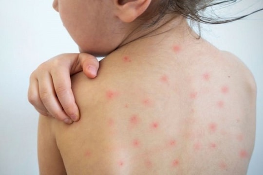 Hơn 1 triệu liều vaccine Sởi-rubella sẽ được tiêm miễn phí
