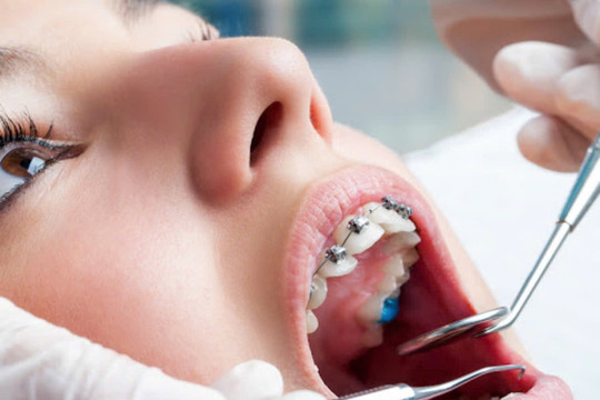 Niềng răng hỏng và những hệ lụy: Góc nhìn từ chuyên gia