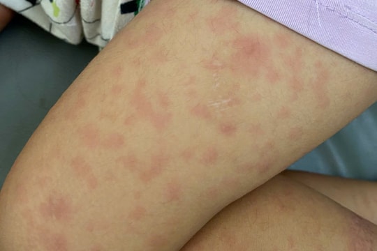 TP.HCM công bố dịch sởi