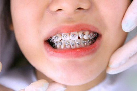 Niềng răng - Làm thế nào để không "tiền mất, tật mang"?