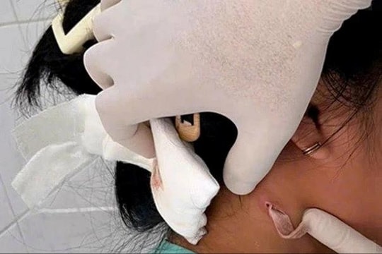 Bé gái Đồng Nai nhiễm ‘vi khuẩn ăn thịt người'