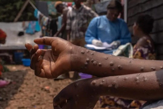 Congo nhận 100.000 liều vaccine mpox đầu tiên