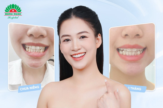 Niềng răng có thể thay đổi được gương mặt?