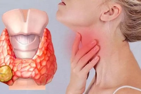 Người dễ mắc ung thư tuyến giáp và cách phòng ngừa