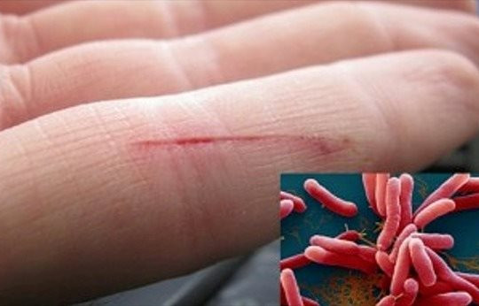 Đã có người nhiễm vi khuẩn “ăn thịt” sau lũ