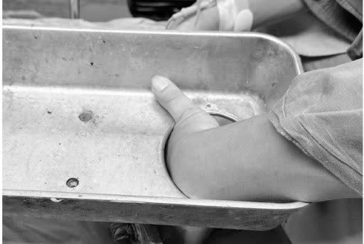 Nhập viện với bàn tay bị cuốn vào máy xay thịt